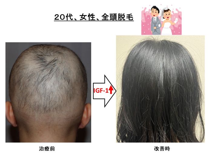 円形脱毛症　病院